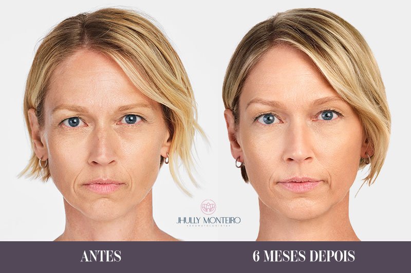 tratamento radiesse antes e depois